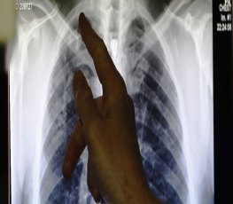 Governo lança Plano Nacional pelo Fim da Tuberculose