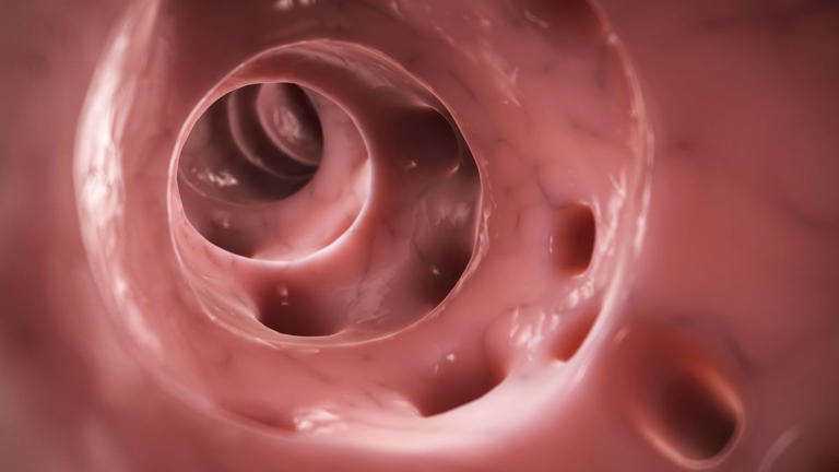 COMO PREVENIR: Diverticulite em jovens vem crescendo 