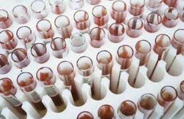 Exame de sangue que detecta síndrome de Down chega ao país 