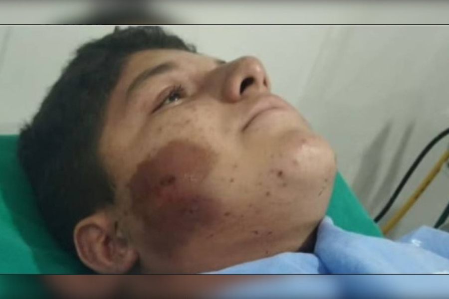 RISCO DE MOBILIDADE: 'Vaquinha' é criada para ajudar adolescente que perdeu dois irmãos em acidente 