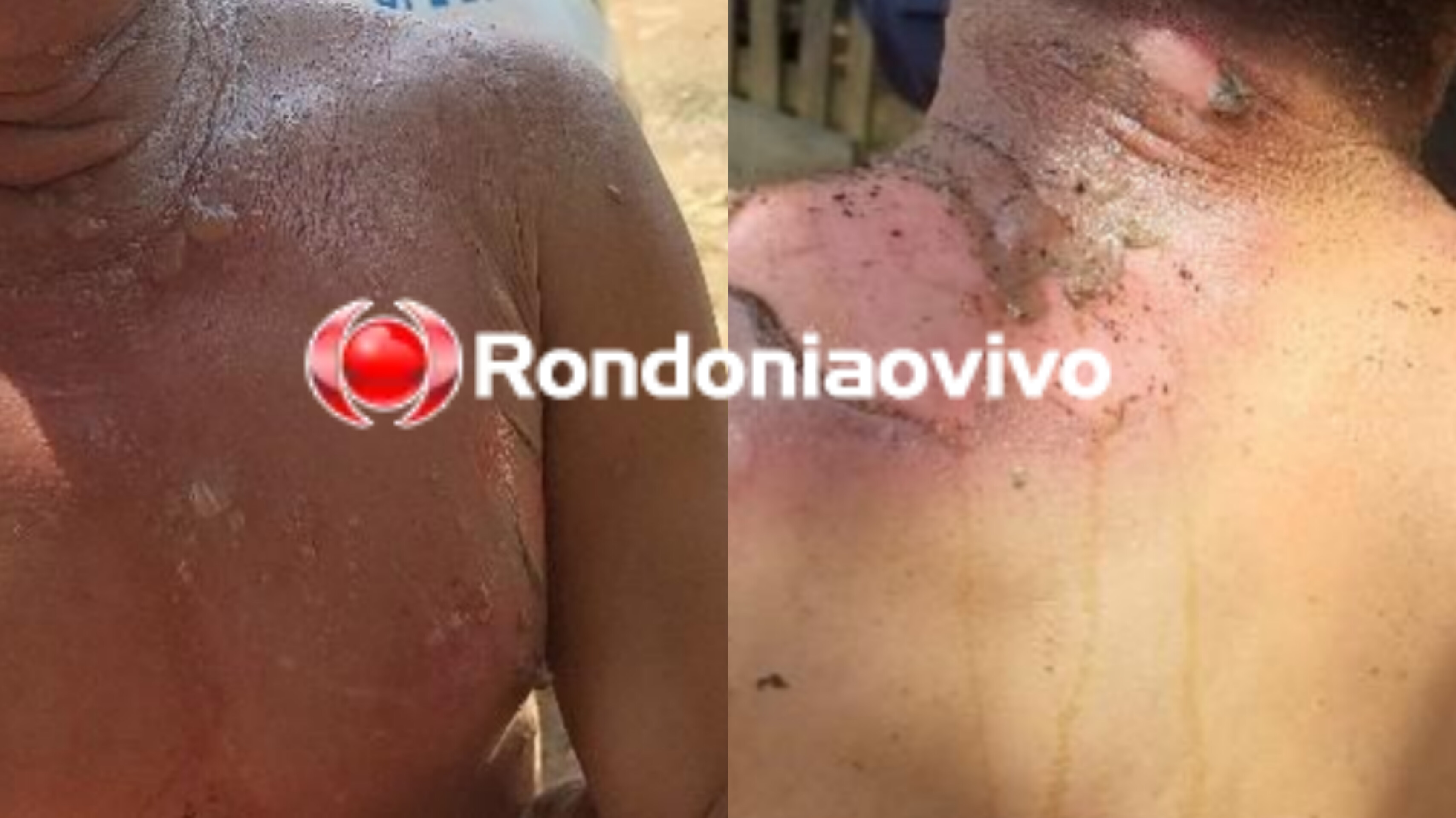 VINGANÇA: Após ser agredida, mulher espera marido dormir e toca fogo nele