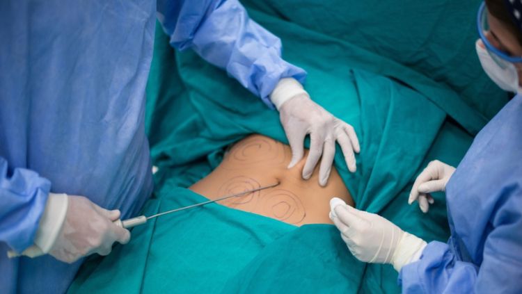 VASER: Equipamento é aliado na lipoaspiração ao quebrar células de gordura, facilitando a sua remoção