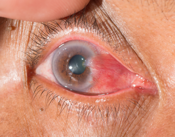 SOLIDARIEDADE: Homem solicita ajuda para realizar cirurgia nos olhos em Porto Velho