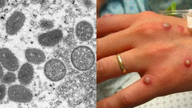 ALERTA: Ministério da Saúde confirma 1ª morte por varíola dos macacos no Brasil