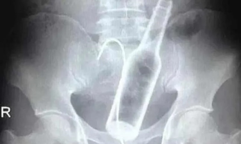 JA FEZ ANTES: Homem vai parar no pronto socorro após enfiar garrafa no ânus