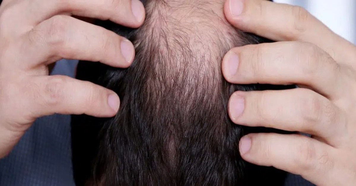 ESCÂNDALO: Além de Viagra, Forças Armadas compraram remédios para calvície