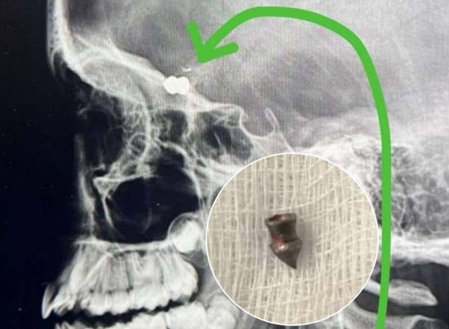 BALA ALOJADA: Menina de 10 anos é atingida com tiro na cabeça; vizinhos são suspeitos