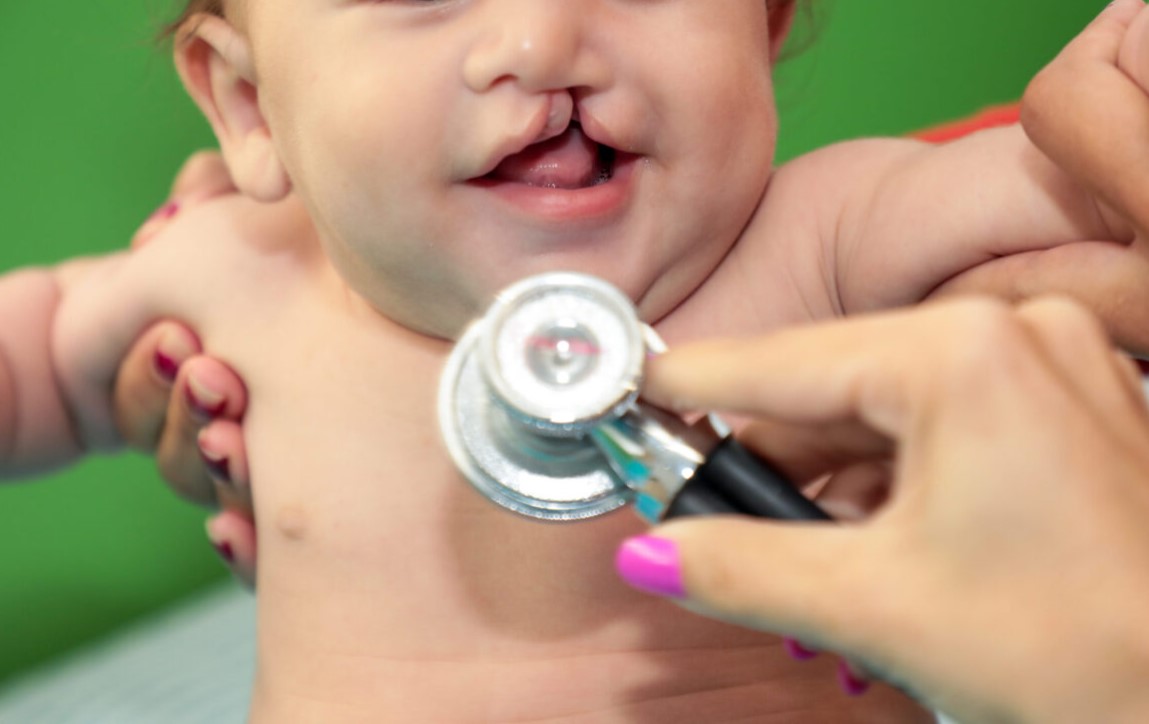 CUIDADO ESPECIALIZADO: Governo agenda consultas para pacientes com fissuras labiopalatinas por WhatsApp