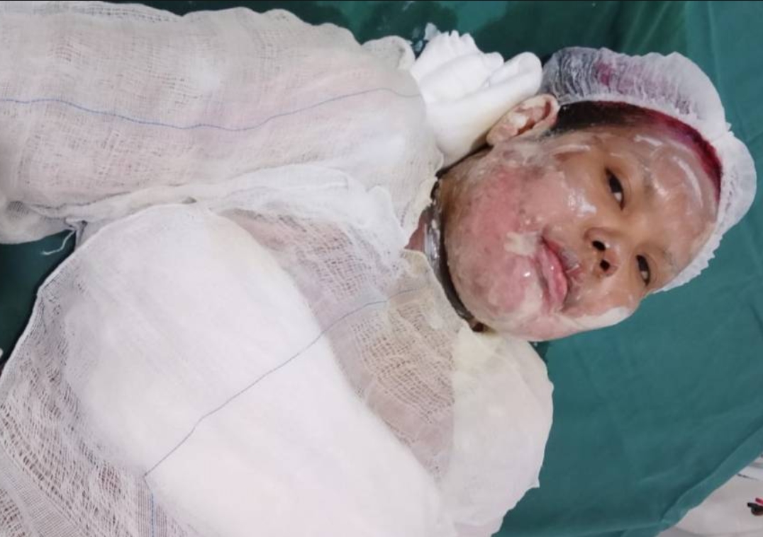 COMO OCORREU?: Mulher morre após sofrer queimaduras graves; família pede investigação