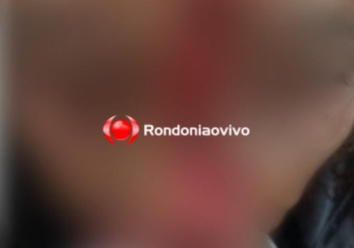 FEROZ: Idosa é atacada gravemente no rosto por cachorro em Porto Velho