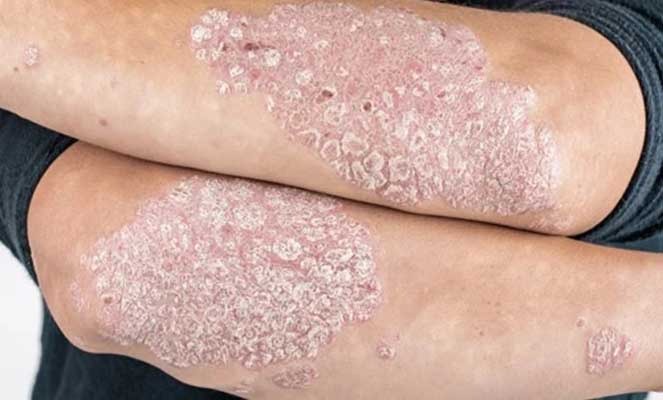 SAÚDE E BEM ESTAR: Psoríase compreendendo suas causas e opções de tratamento