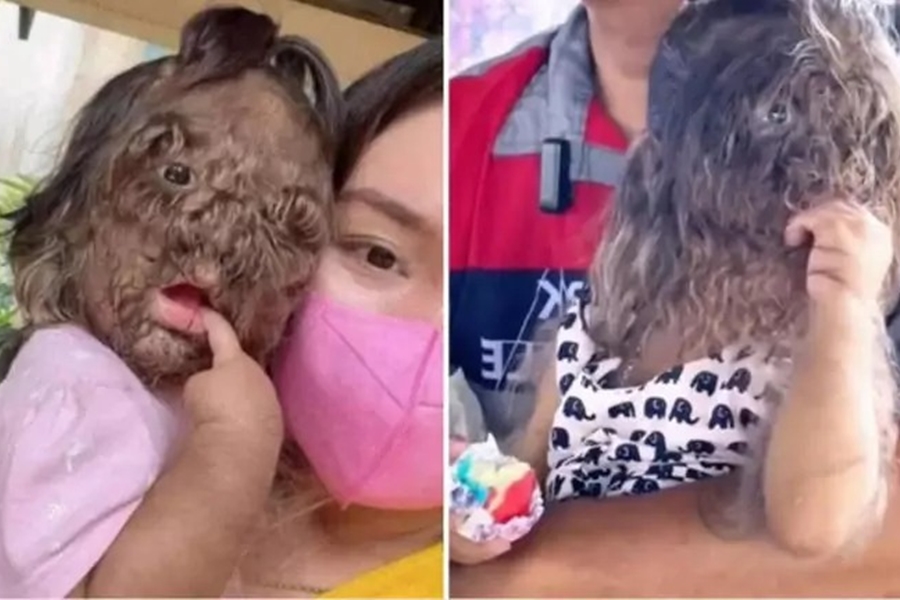 RARIDADE: Menina sofre de ‘síndrome do lobisomem’; pais querem desmistificar doença