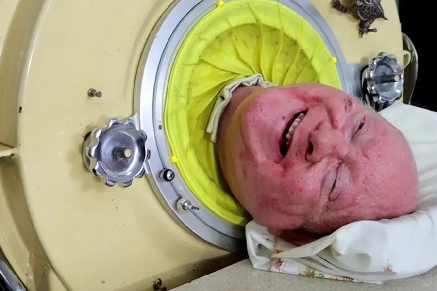 PESAR: Morre homem que viveu mais de 70 anos em 'pulmão de ferro'