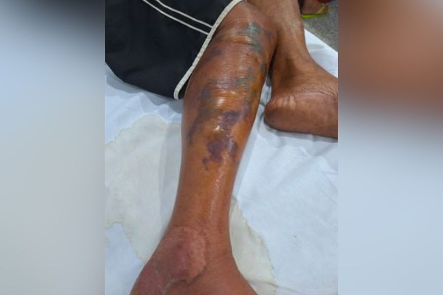 APELO: Homem pode ficar sem a perna por imprudência médica, diz sobrinha