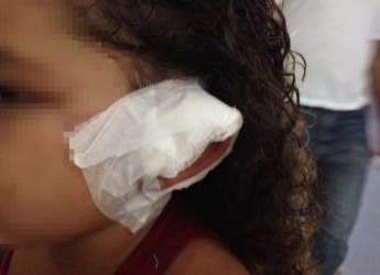 Criança tem parte do couro cabeludo arrancado em acidente em parque de diversão