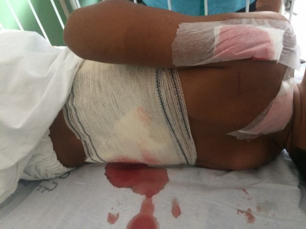 MORDIDAS: Cachorro ataca criança de 11 anos