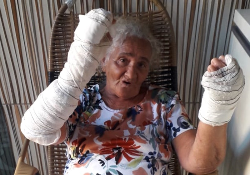 AJUDA: Idosa sofre queimaduras ao usar soda cáustica enquanto fazia sabão