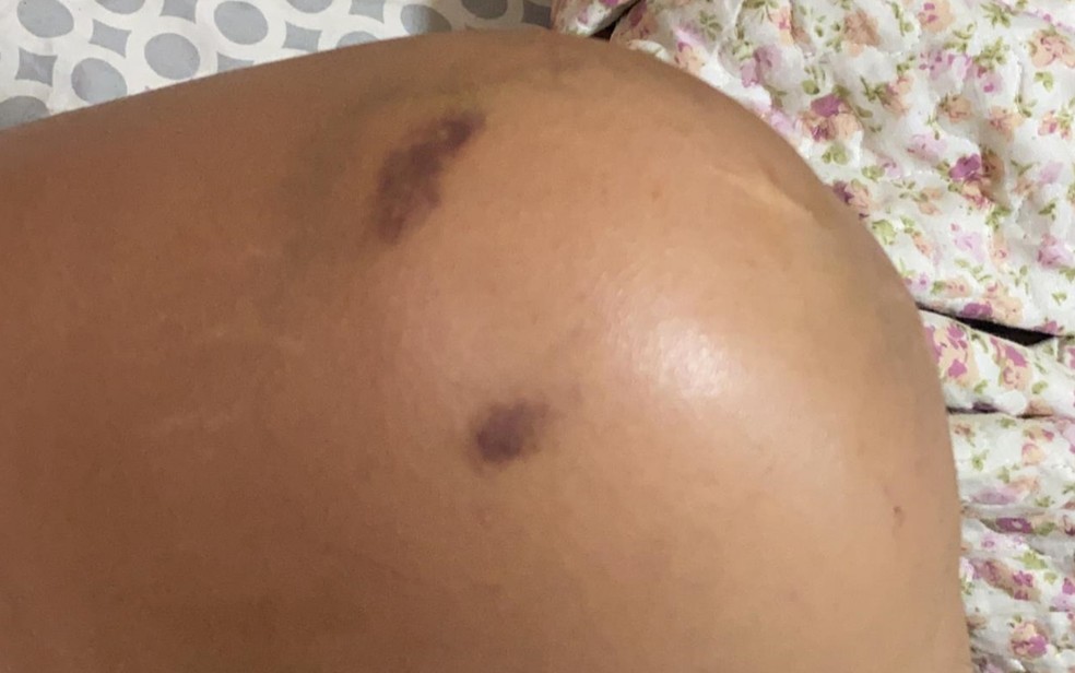 HOSPITALIZADA: Mulher é espancada pelo amigo de infância ao reagir estupro