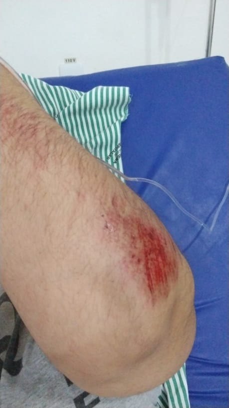 QUEDA BRUSCA: Motociclista fica banguela após acidente com gato em RO