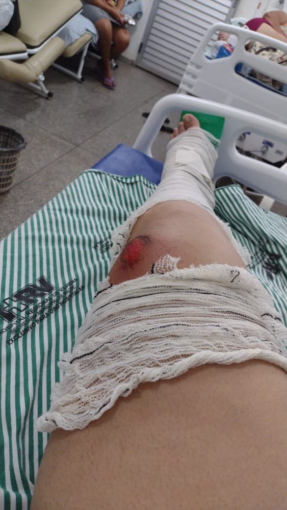 QUEDA BRUSCA: Motociclista fica banguela após acidente com gato em RO