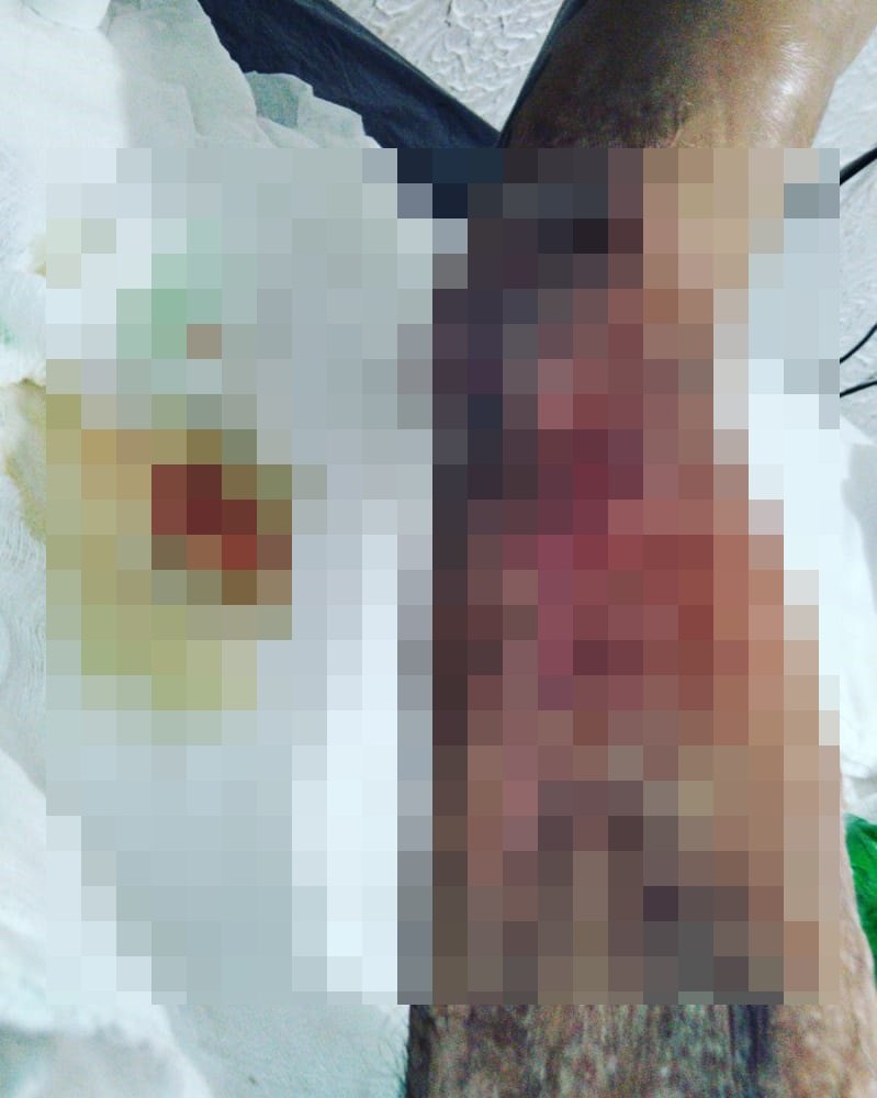 SOLIDARIEDADE: Motoboy que sofreu acidente precisa de ajuda para realizar cirurgia de urgência