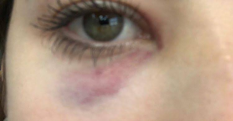 ABSURDO: Mulher tem nariz quebrado ao ler mensagens da amante no celular do marido