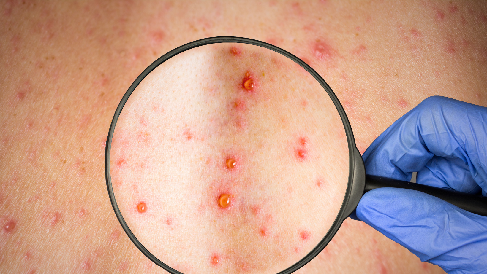 DOENÇA: OMS declara varíola dos macacos como emergência de saúde global