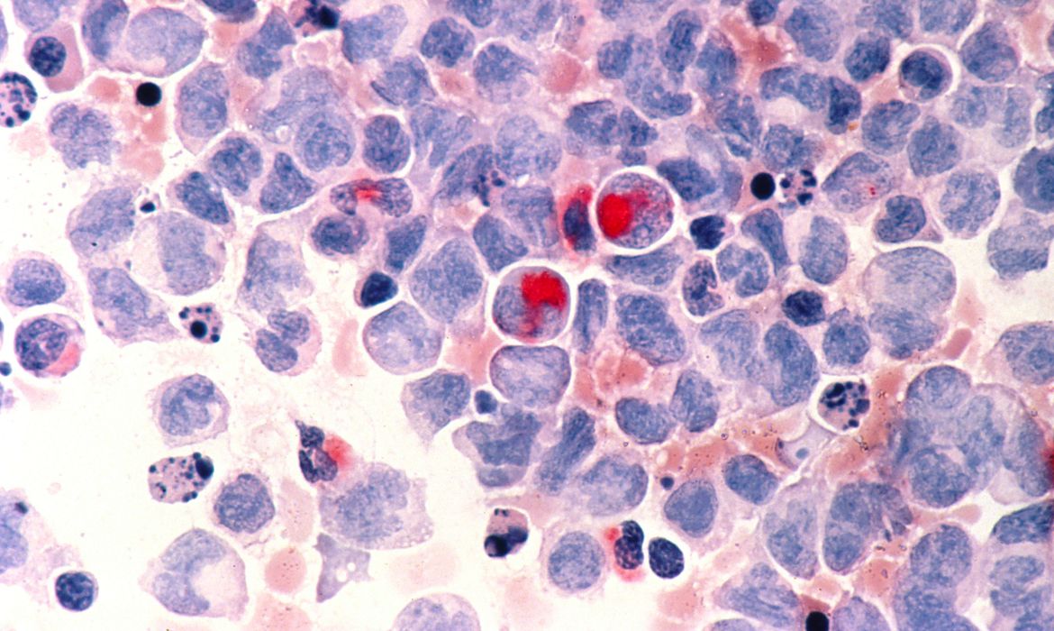 TRATAMENTO: ANS inclui opções de quimioterapia oral em seu rol de procedimentos