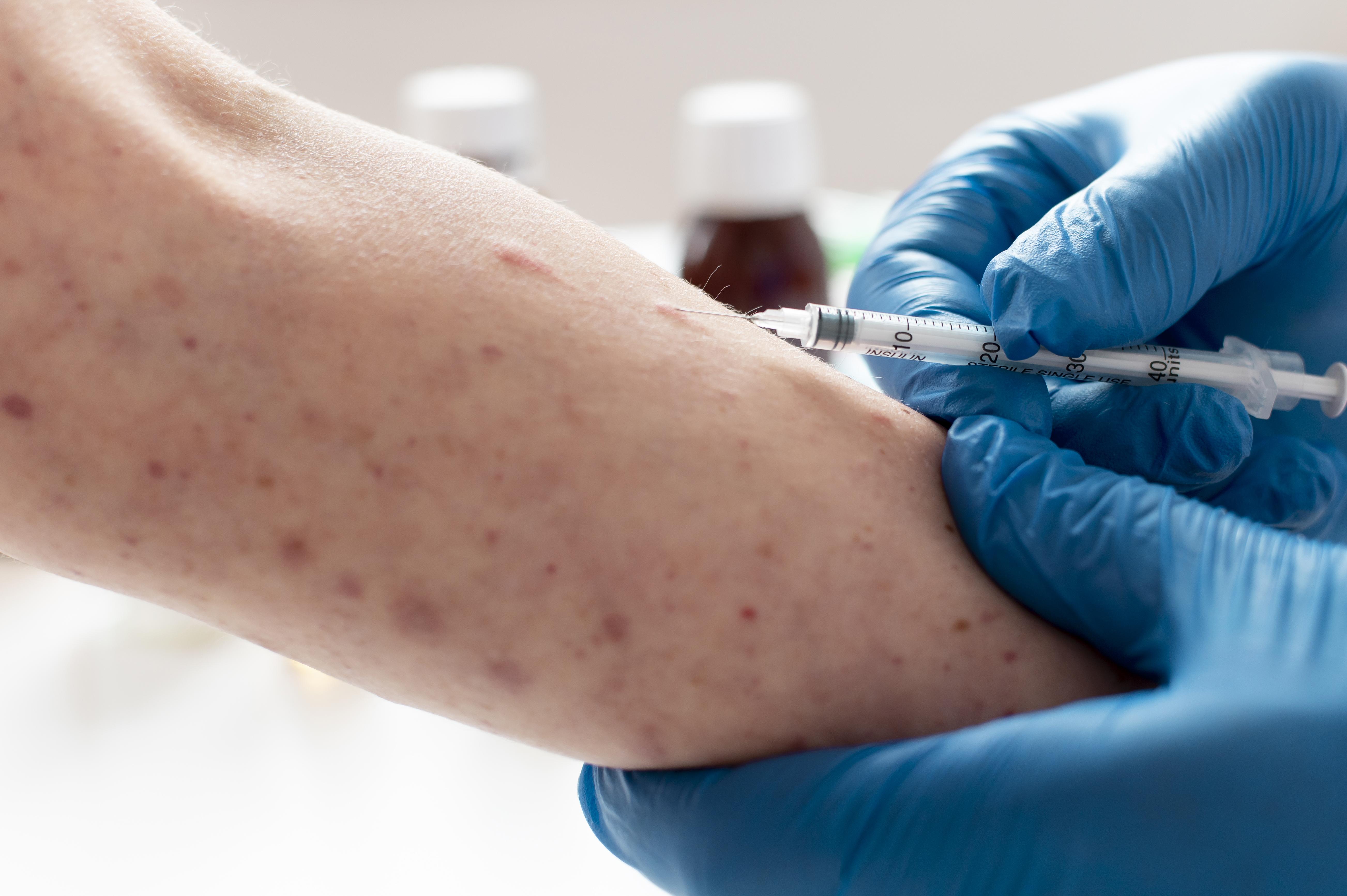 ALERTA SANITÁRIO: Brasil registra avanço de Mpox e Rondônia tem casos confirmados 